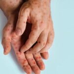 Chihuahua registra 1,677 casos de sarampión y nueve hospitalizados. El brote se ha extendido a 38 municipios y autoridades implementan campañas masivas de vacunación para contener la enfermedad.