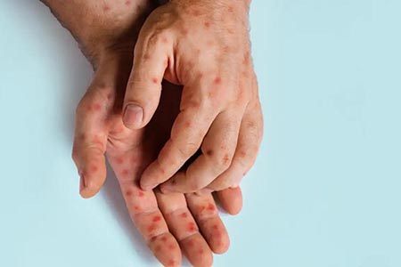 Chihuahua registra 1,677 casos de sarampión y nueve hospitalizados. El brote se ha extendido a 38 municipios y autoridades implementan campañas masivas de vacunación para contener la enfermedad.