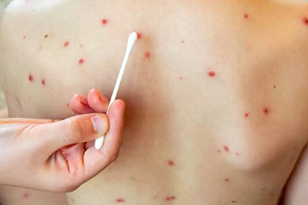 Chihuahua registra 1,400 casos de sarampión en 34 municipios. Cuauhtémoc lidera con 669 contagios. Autoridades recomiendan vacunación urgente, uso de cubrebocas y gel antibacterial para evitar más brotes.