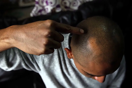 Científicos del Hospital Clínico San Carlos desarrollan una terapia con células madre y ATP que logró regenerar cabello en ratones con alopecia androgénica. El tratamiento podría llegar en cinco años.