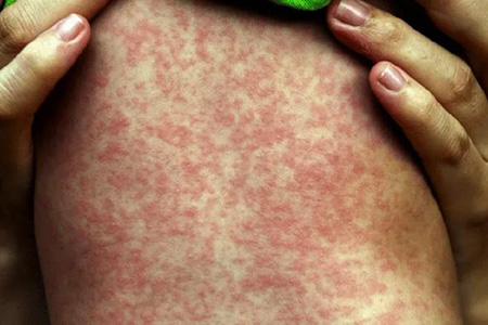 Chihuahua enfrenta un brote de sarampión con más de 1,800 contagios en 39 municipios. Cuatro muertes han sido confirmadas, todas por falta de vacunación o enfermedades preexistentes.
