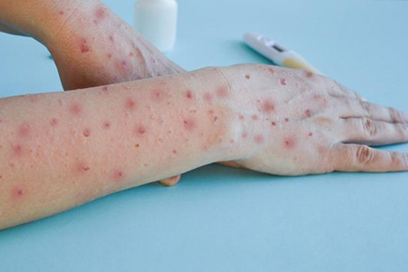 Los contagios de sarampión en Chihuahua crecieron un 58% en junio, alcanzando 2,752 casos y ocho muertes. Cuauhtémoc concentra la mayoría de infecciones.