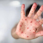 Cerca de 4 mil contagios de sarampión se han registrado en Chihuahua Salud