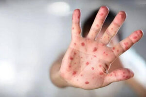Chihuahua enfrenta un brote de sarampión con 3,972 contagios confirmados en 47 municipios. Cuauhtémoc y la capital concentran la mayor parte de los casos. Autoridades llaman a reforzar la vacunación y medidas de prevención ante 14 fallecimientos en 2025.